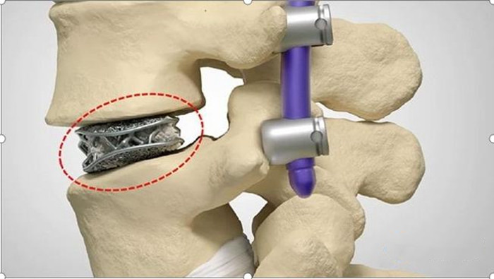 3d printed medical implants