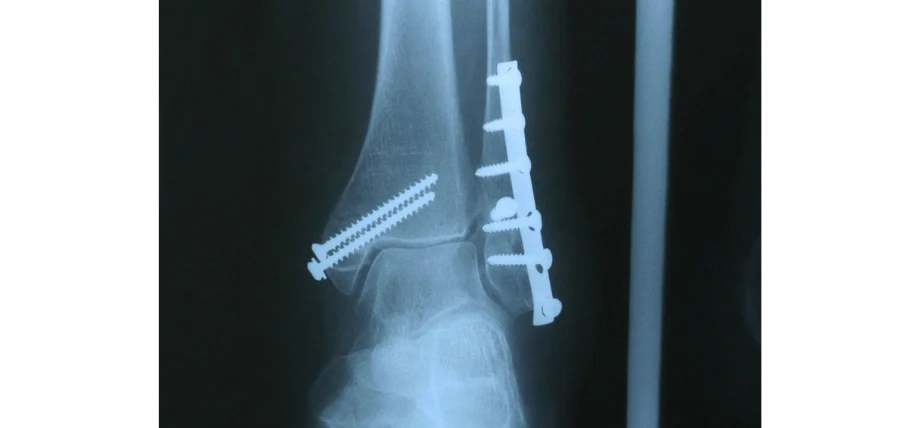 X-ray of bone screws set in an ankle