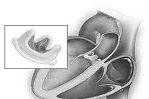 Heart Valves