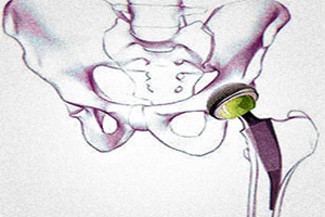 Hip Prosthesis