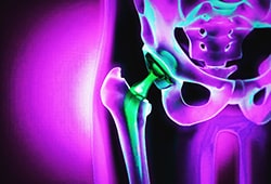 Orthopedic Implants in the Medical Industry