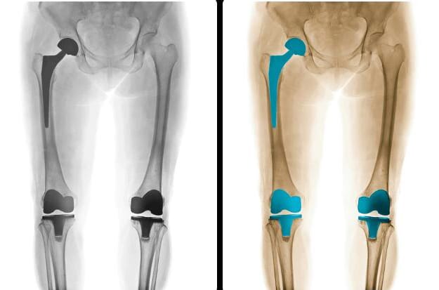joint implant